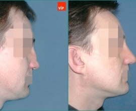 Nâng mũi bằng sụn vách ngăn, Nâng vùng giữa mặt
