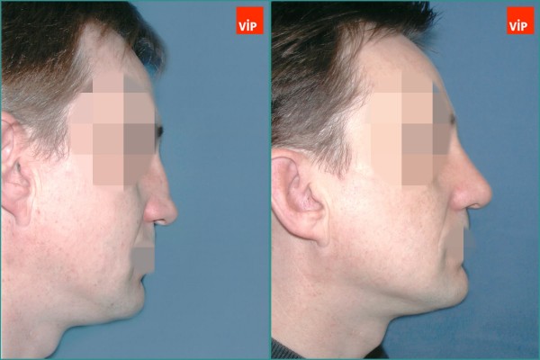 Nose Surgery - Nâng mũi bằng sụn vách ngăn, Nâng vùng giữa mặt