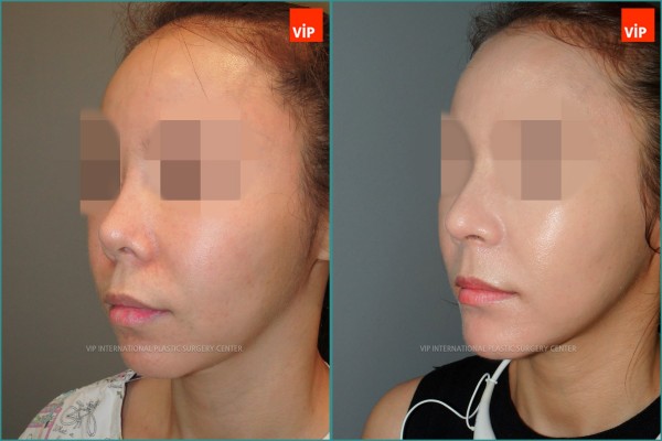Nose Surgery - Nâng mũi bằng sụn sườn