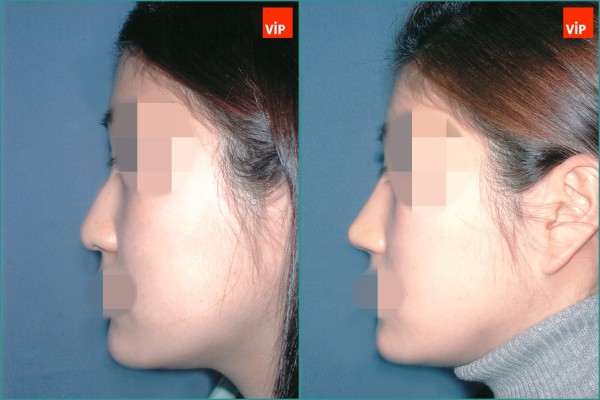Nose Surgery - Nâng mũi bằng sụn vách ngăn