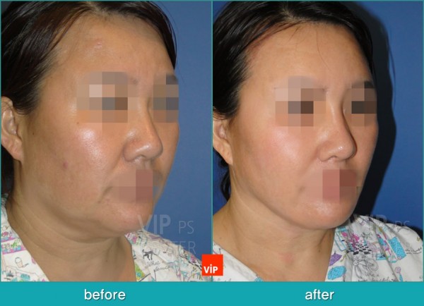 Face Lift - Căng da mặt/cổ High-Smas