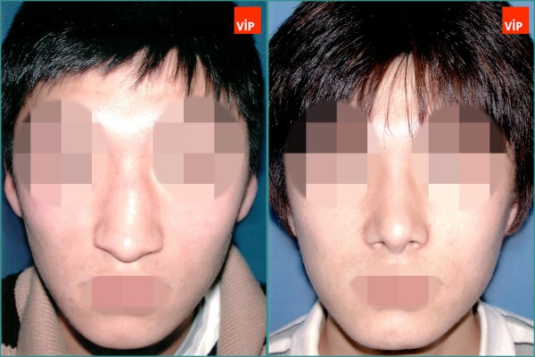 Nose Surgery - Mũi khoằm