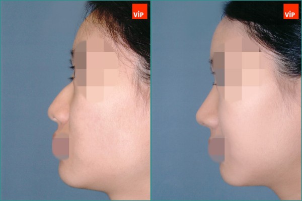 Nose Surgery - Mũi gồ