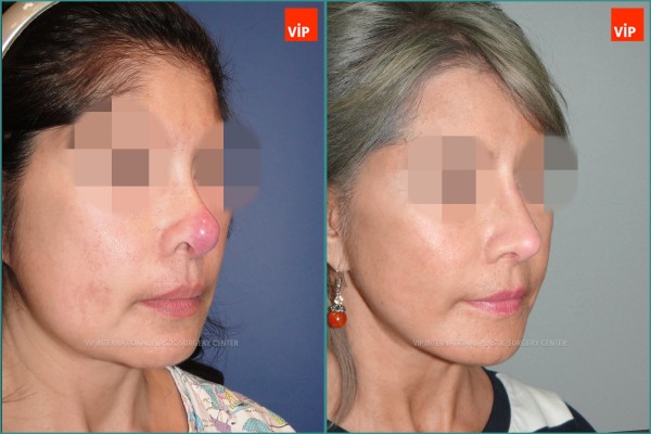 Nose Surgery - Căng da mặt, Tái phẫu thuật mũi, Nâng mũi bằng sụn sườn