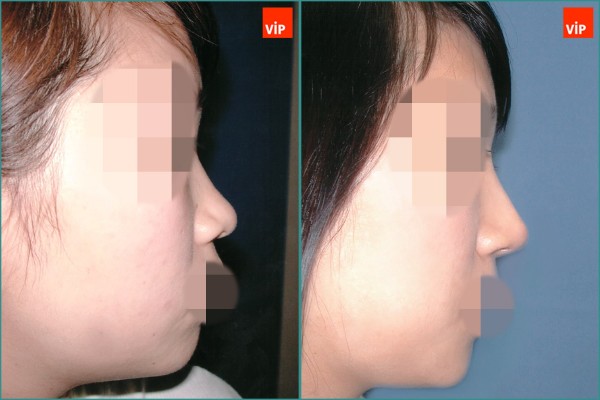 Nose Surgery - Nâng mũi bằng sụn vách ngăn
