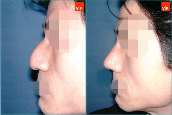 Nose Surgery - Mũi gồ