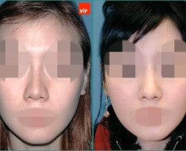 Nâng mũi bằng sụn vách ngăn