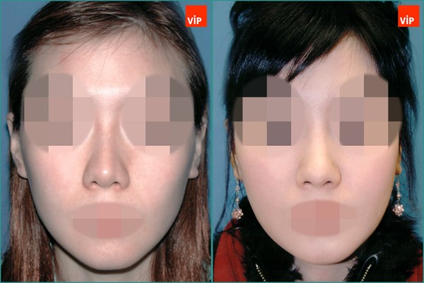 Nose Surgery - Nâng mũi bằng sụn vách ngăn