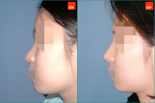 Nose Surgery - Nâng mũi bằng sụn vách ngăn