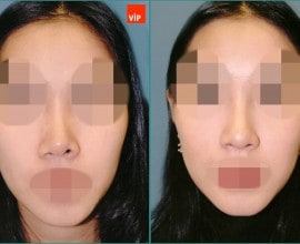 Nâng mũi bằng sụn vách ngăn