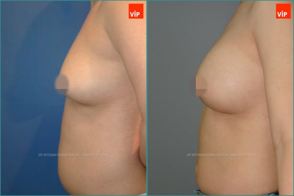 Breast Surgery - Nâng ngực
