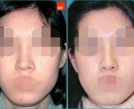 Nâng mũi bằng sụn vách ngăn