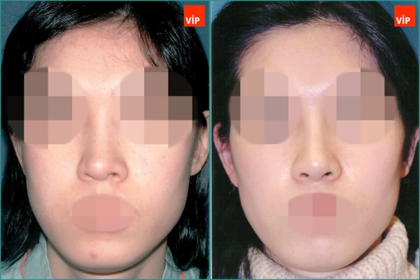 Nose Surgery - Nâng mũi bằng sụn vách ngăn