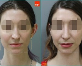 Nâng mũi bằng sụn vách ngăn