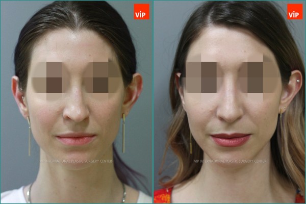 Nose Surgery - Nâng mũi bằng sụn vách ngăn