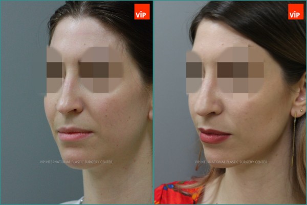 Nose Surgery - Nâng mũi bằng sụn vách ngăn
