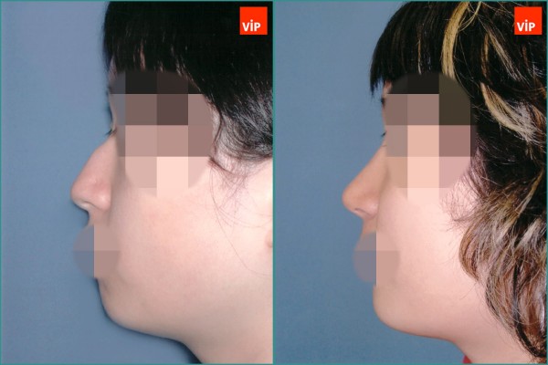 Nose Surgery - Mũi gồ