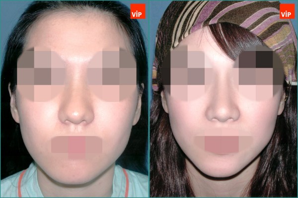 Nose Surgery - Mũi gồ