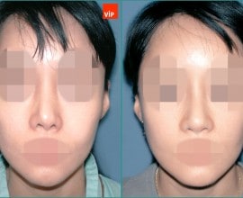 Nâng mũi bằng sụn sườn