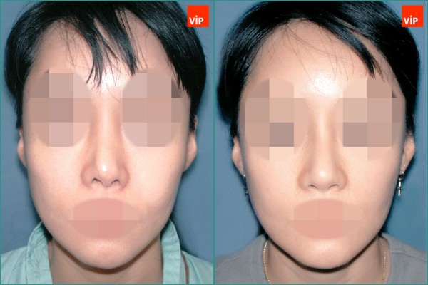 Nose Surgery - Nâng mũi bằng sụn sườn