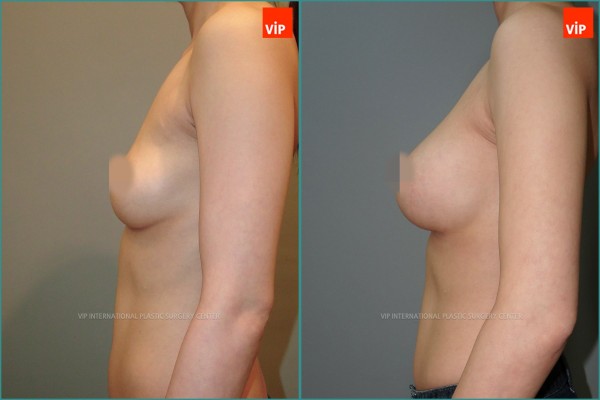 Breast Surgery - Nâng ngực