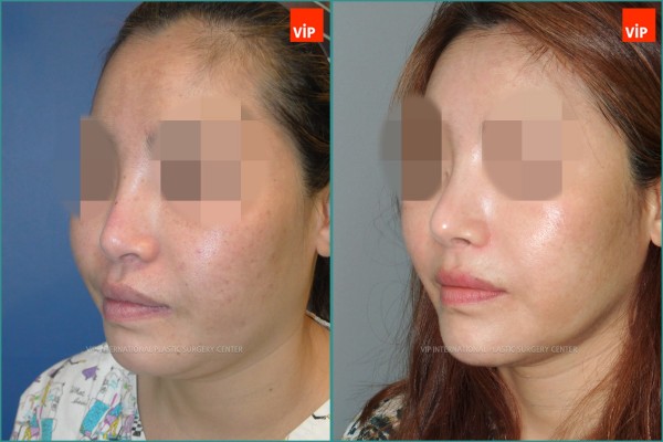 Nose Surgery - Nâng mũi bằng sụn sườn