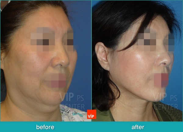 Face Lift - Căng da mặt/cổ High SMAS
