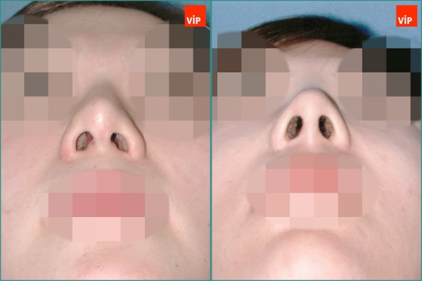 Nose Surgery - Nâng mũi bằng sụn vách ngăn