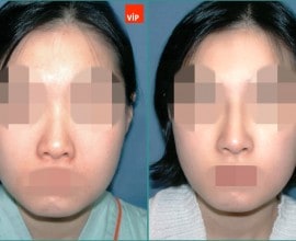 Nâng mũi bằng sụn sườn