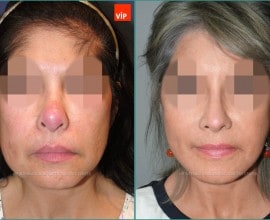 Căng da mặt, Tái phẫu thuật mũi, Nâng mũi bằng sụn sườn