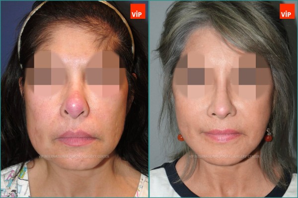 Nose Surgery - Căng da mặt, Tái phẫu thuật mũi, Nâng mũi bằng sụn sườn