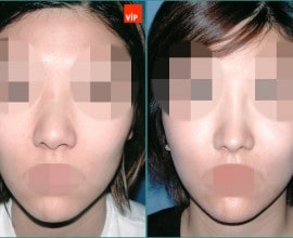 Nâng mũi bằng sụn vách ngăn