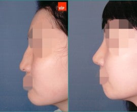 Nâng mũi bằng sụn vách ngăn