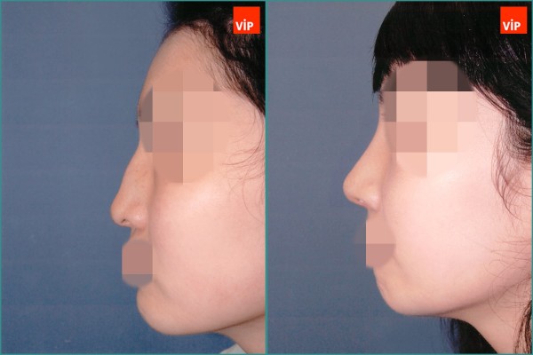 Nose Surgery - Nâng mũi bằng sụn vách ngăn