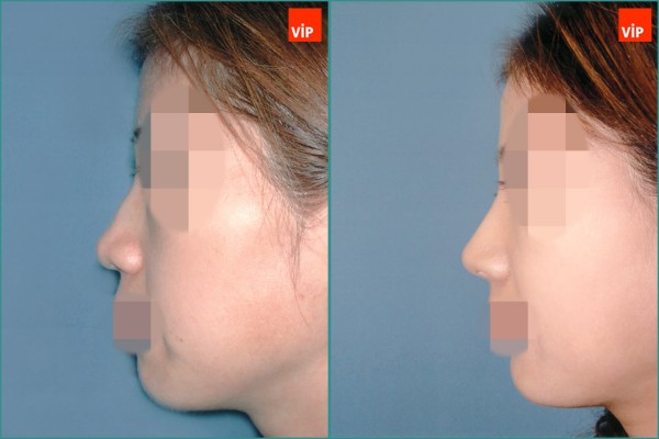 Nose Surgery - Nâng mũi bằng sụn vách ngăn