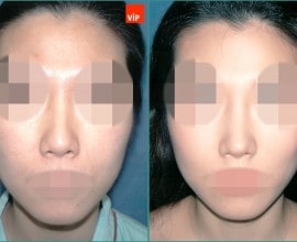 Nâng mũi bằng sụn vách ngăn