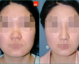 Nâng mũi bằng sụn vách ngăn