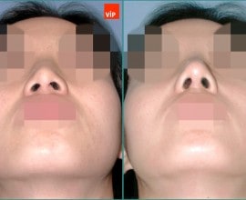 Nâng mũi bằng sụn vách ngăn