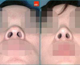 Nâng mũi bằng sụn vách ngăn
