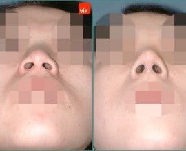 Nâng mũi bằng sụn vách ngăn
