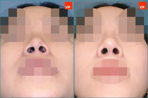 Nose Surgery - Nâng mũi bằng sụn vách ngăn