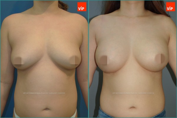 Breast Surgery - Nâng ngực