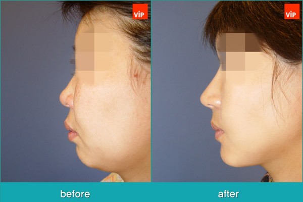 Nose Surgery, Facial Bone Surgery, Stem Cell Fat Graft - Nâng mũi bằng sụn sườn,  Phẫu thuật tạo đường nét trên khuôn mặt, Phẫu thuật gọt hàm, Hạ gò má, Cấy mỡ