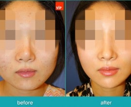 Phẫu thuật tạo đường nét trên khuôn mặt, Phẫu thuật gọt hàm,…