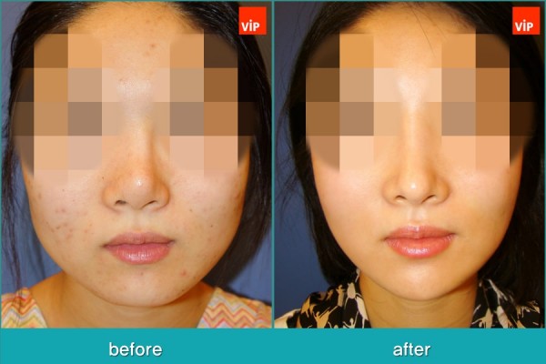 Nose Surgery, Facial Bone Surgery - Phẫu thuật tạo đường nét trên khuôn mặt, Phẫu thuật gọt hàm, Nâng mũi bằng sụn sườn