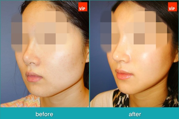 Nose Surgery, Facial Bone Surgery - Phẫu thuật tạo đường nét trên khuôn mặt, Phẫu thuật gọt hàm, Nâng mũi bằng sụn sườn