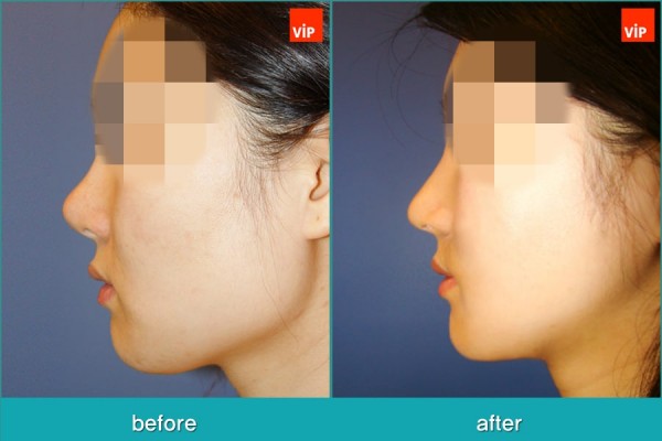 Nose Surgery, Facial Bone Surgery - Phẫu thuật tạo đường nét trên khuôn mặt, Phẫu thuật gọt hàm, Nâng mũi bằng sụn sườn