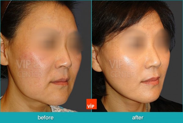 Face Lift - Căng da mặt/cổ High-SMAS