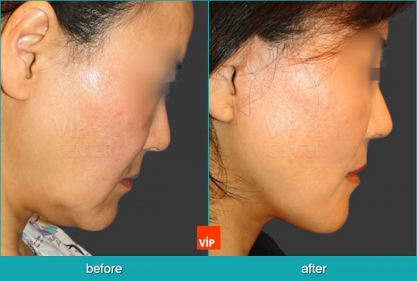 Face Lift - Căng da mặt/cổ High-SMAS