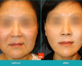 Căng da mặt/cổ High-SMAS